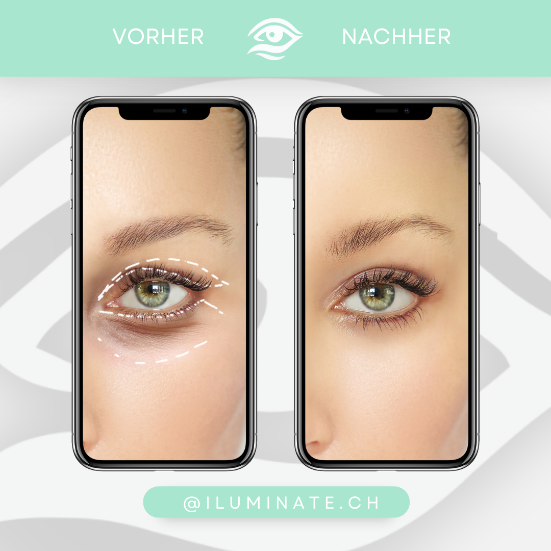 iLuminate – Rotlichttherapie Beauty Brille